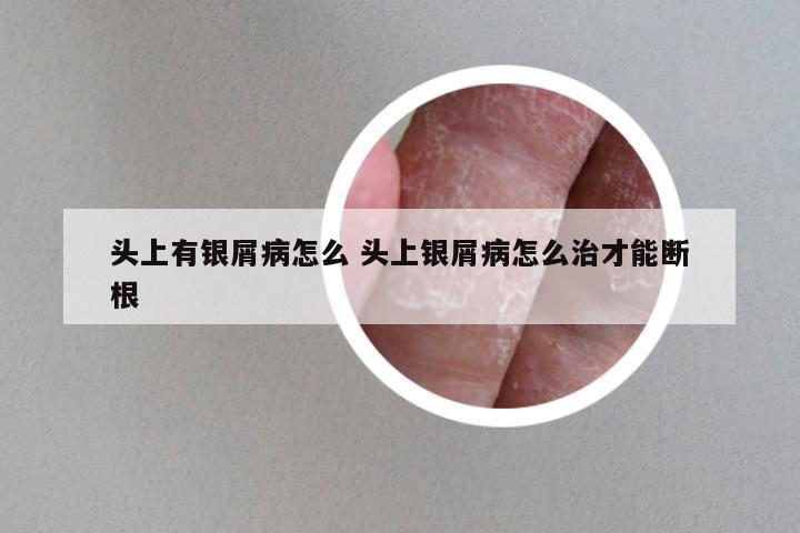 头上有银屑病怎么 头上银屑病怎么治才能断根