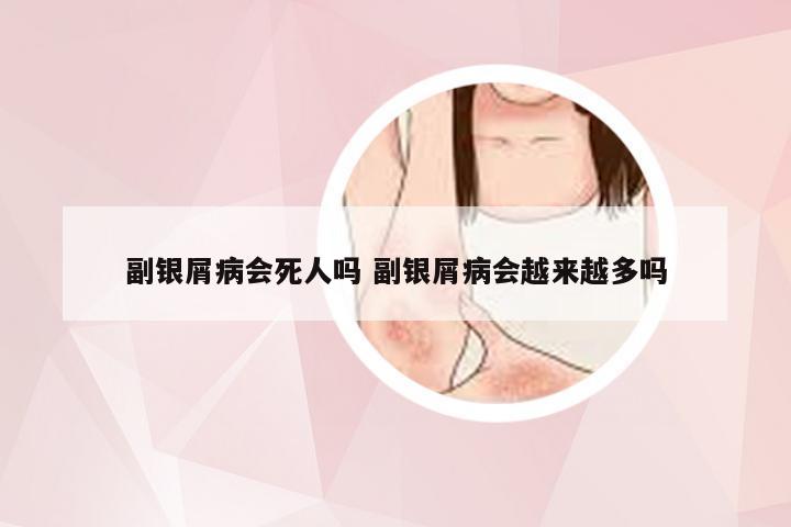 副银屑病会死人吗 副银屑病会越来越多吗