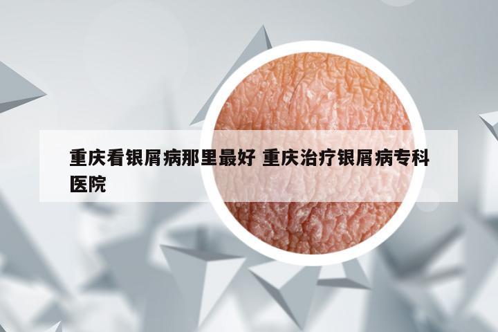 重庆看银屑病那里最好 重庆治疗银屑病专科医院