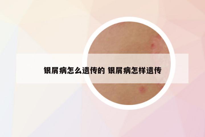 银屑病怎么遗传的 银屑病怎样遗传