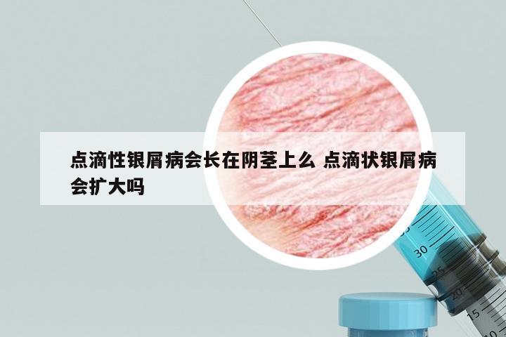点滴性银屑病会长在阴茎上么 点滴状银屑病会扩大吗