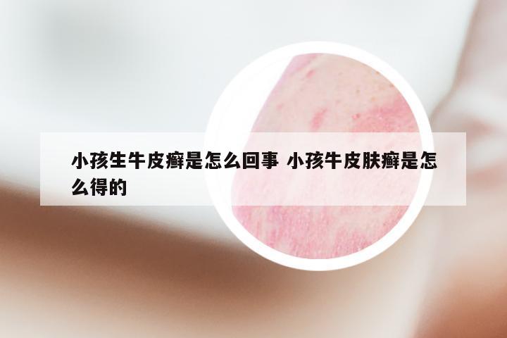 小孩生牛皮癣是怎么回事 小孩牛皮肤癣是怎么得的