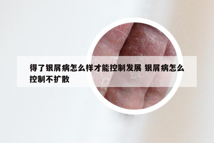得了银屑病怎么样才能控制发展 银屑病怎么控制不扩散