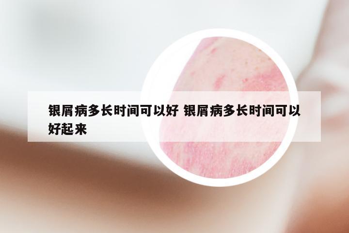 银屑病多长时间可以好 银屑病多长时间可以好起来