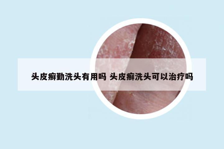 头皮癣勤洗头有用吗 头皮癣洗头可以治疗吗