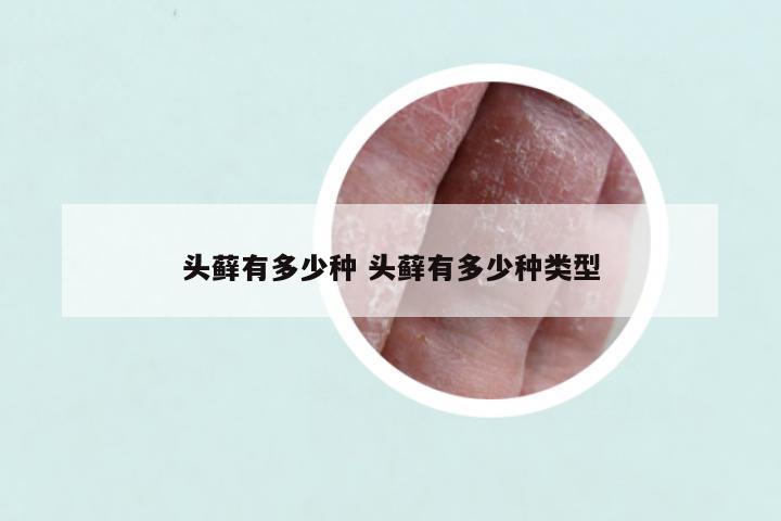 头藓有多少种 头藓有多少种类型