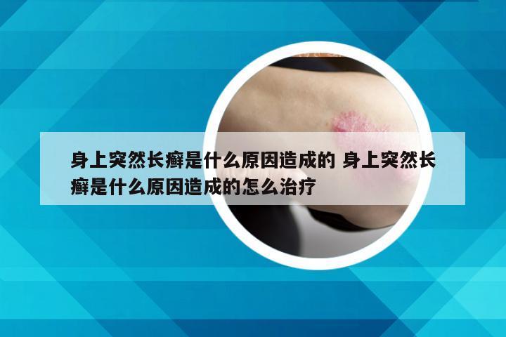 身上突然长癣是什么原因造成的 身上突然长癣是什么原因造成的怎么治疗