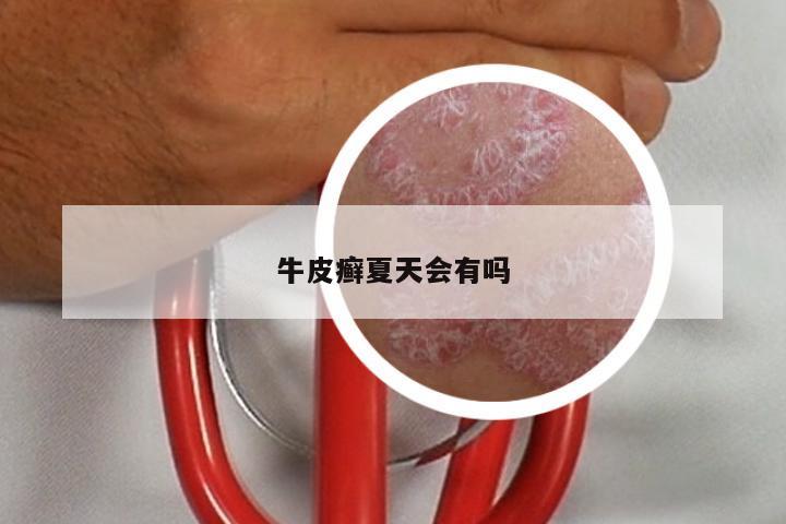 牛皮癣夏天会有吗