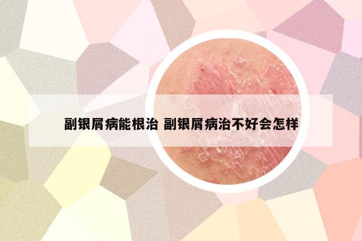 副银屑病能根治 副银屑病治不好会怎样