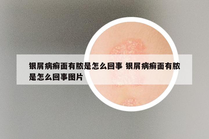 银屑病癣面有脓是怎么回事 银屑病癣面有脓是怎么回事图片