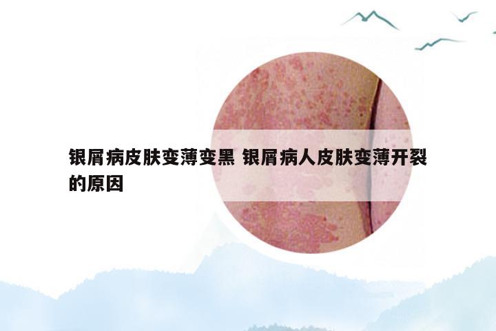 银屑病皮肤变薄变黑 银屑病人皮肤变薄开裂的原因