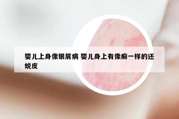婴儿上身像银屑病 婴儿身上有像癣一样的还蜕皮