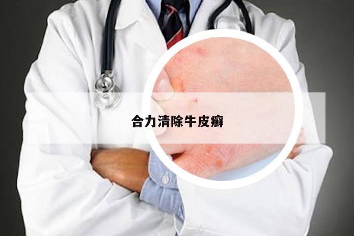 合力清除牛皮癣
