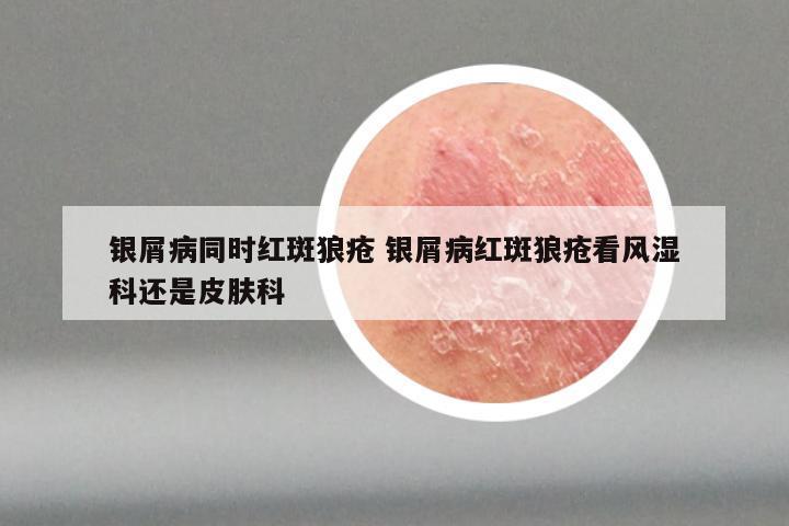 银屑病同时红斑狼疮 银屑病红斑狼疮看风湿科还是皮肤科
