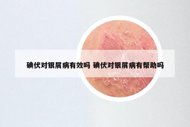 碘伏对银屑病有效吗 碘伏对银屑病有帮助吗