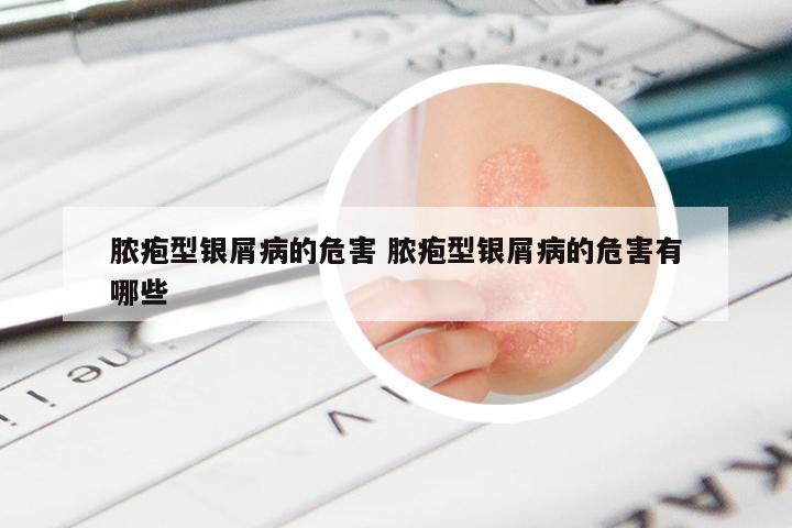 脓疱型银屑病的危害 脓疱型银屑病的危害有哪些