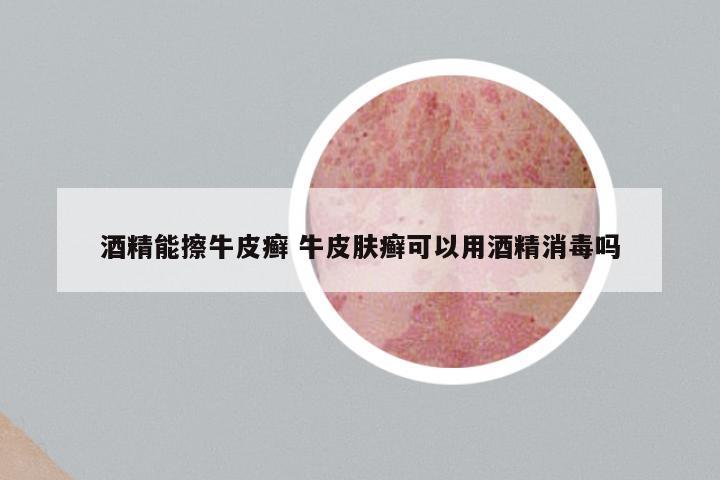 酒精能擦牛皮癣 牛皮肤癣可以用酒精消毒吗