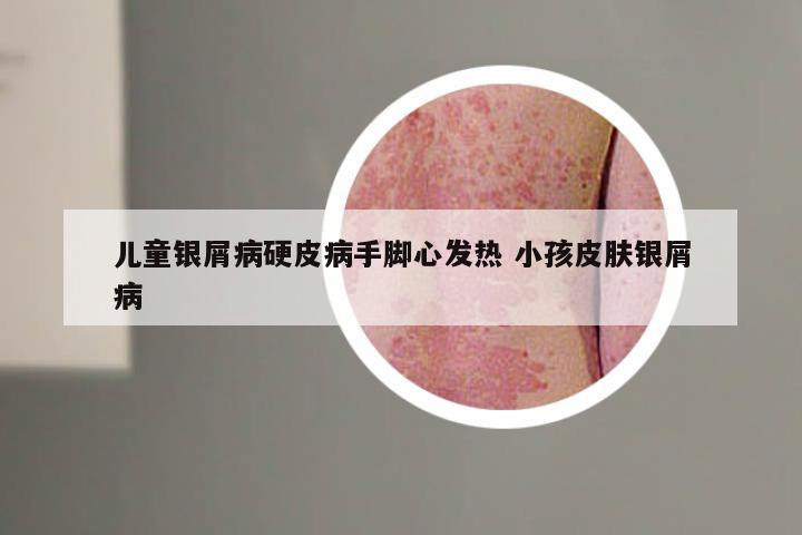 儿童银屑病硬皮病手脚心发热 小孩皮肤银屑病