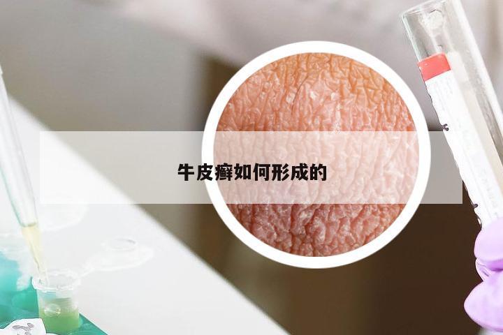 牛皮癣如何形成的