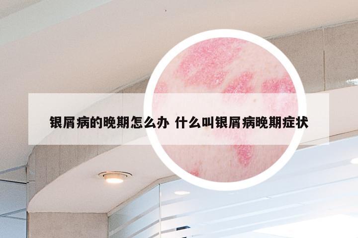 银屑病的晚期怎么办 什么叫银屑病晚期症状