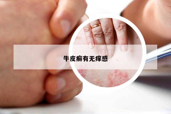 牛皮癣有无痒感