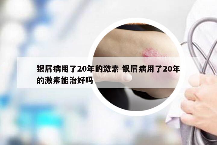 银屑病用了20年的激素 银屑病用了20年的激素能治好吗