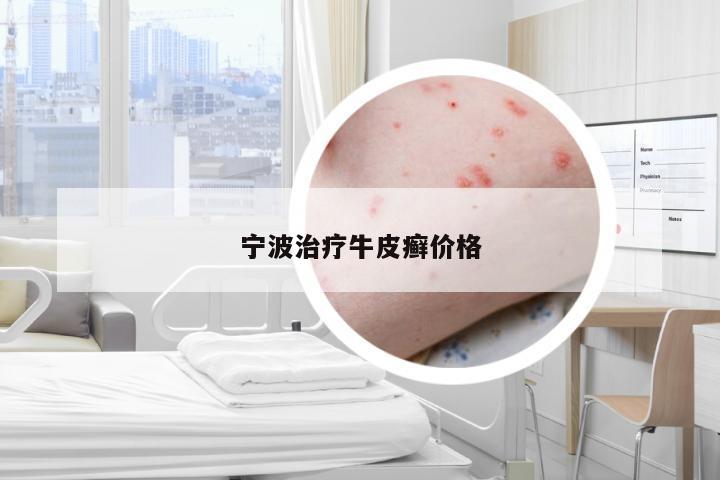 宁波治疗牛皮癣价格