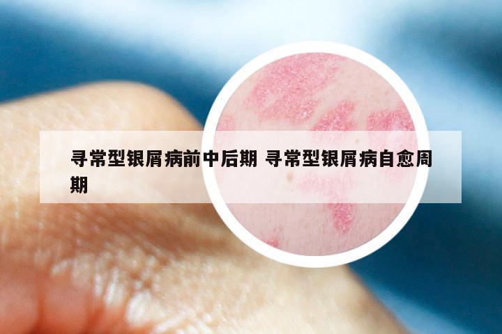 寻常型银屑病前中后期 寻常型银屑病自愈周期