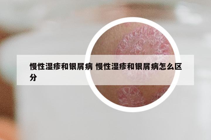 慢性湿疹和银屑病 慢性湿疹和银屑病怎么区分