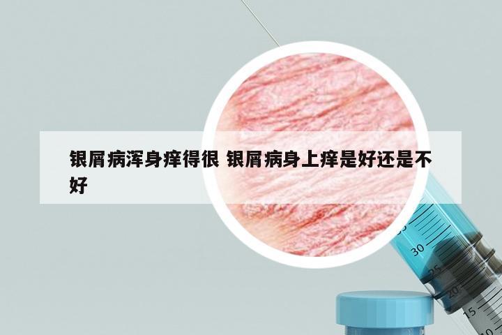银屑病浑身痒得很 银屑病身上痒是好还是不好
