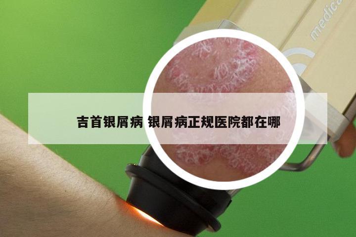 吉首银屑病 银屑病正规医院都在哪