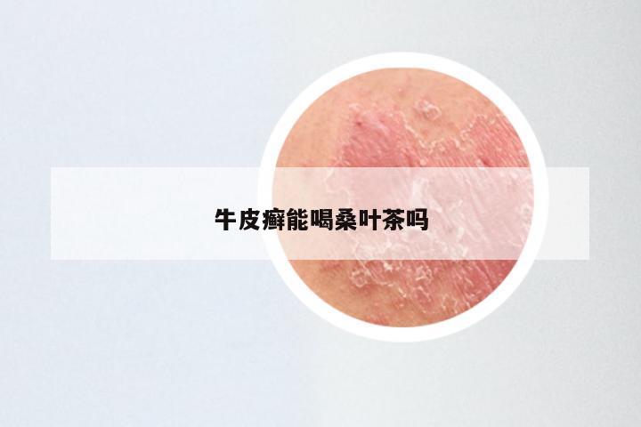 牛皮癣能喝桑叶茶吗