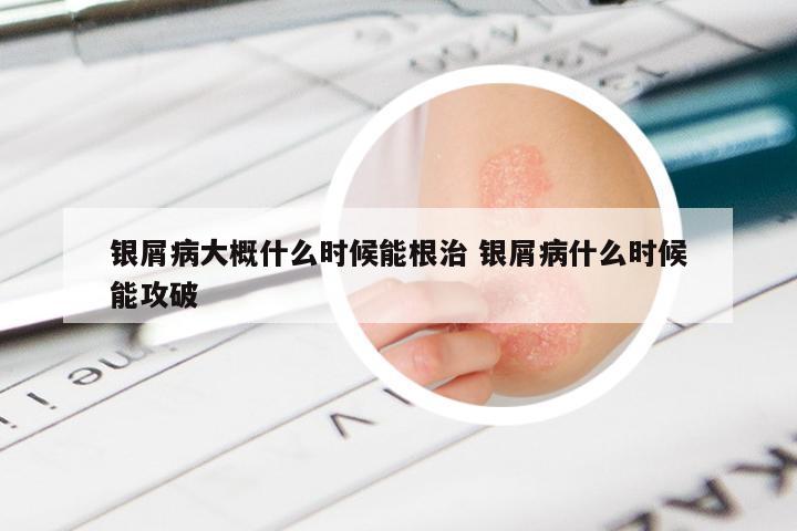 银屑病大概什么时候能根治 银屑病什么时候能攻破