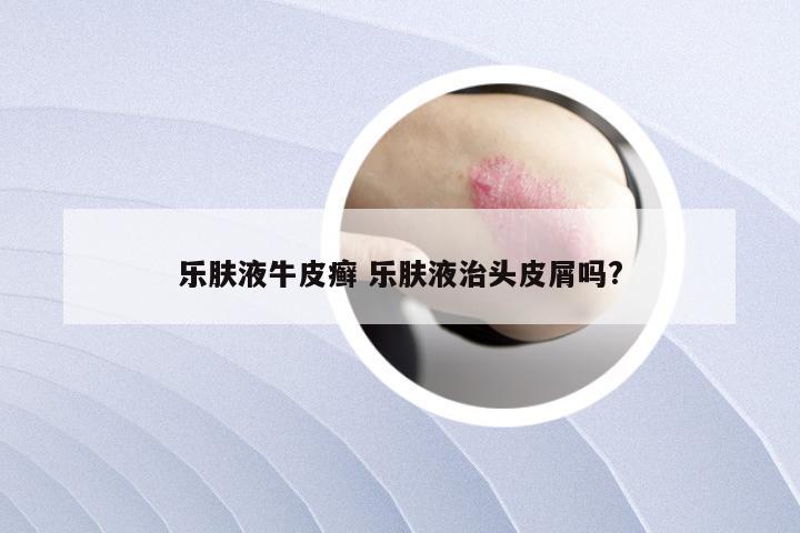 乐肤液牛皮癣 乐肤液治头皮屑吗?