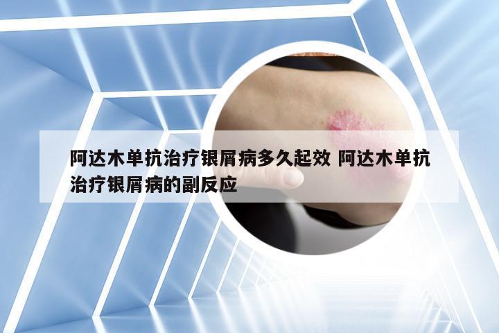 阿达木单抗治疗银屑病多久起效 阿达木单抗治疗银屑病的副反应