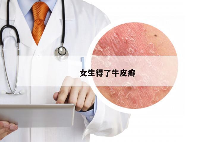女生得了牛皮癣