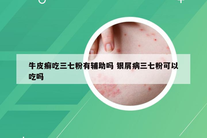 牛皮癣吃三七粉有辅助吗 银屑病三七粉可以吃吗