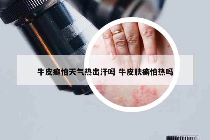 牛皮癣怕天气热出汗吗 牛皮肤癣怕热吗