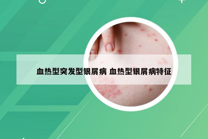 血热型突发型银屑病 血热型银屑病特征
