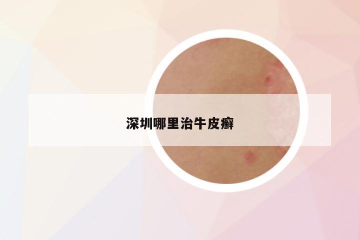 深圳哪里治牛皮癣