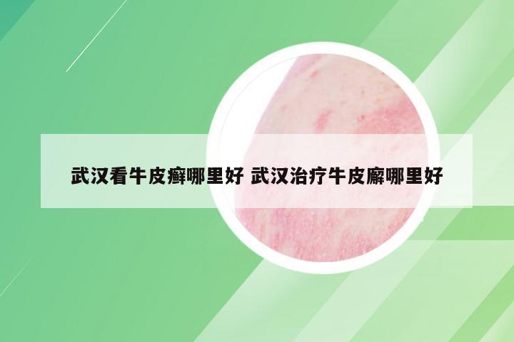 武汉看牛皮癣哪里好 武汉治疗牛皮廨哪里好