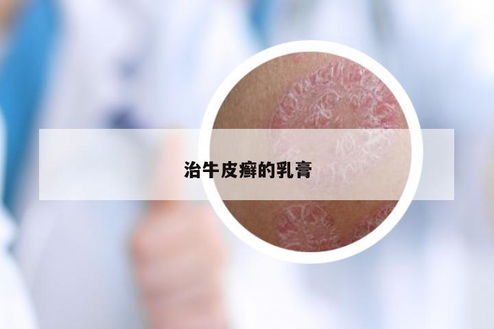 治牛皮癣的乳膏