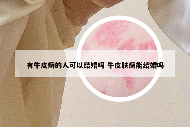 有牛皮癣的人可以结婚吗 牛皮肤癣能结婚吗