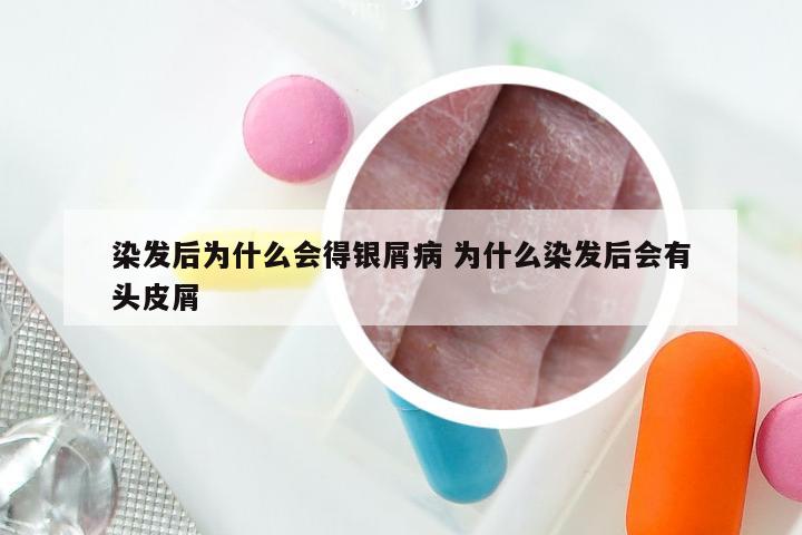 染发后为什么会得银屑病 为什么染发后会有头皮屑