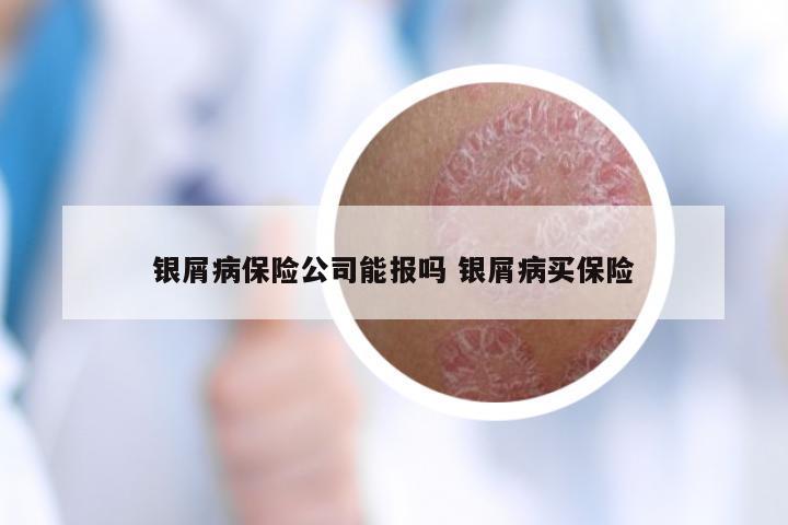 银屑病保险公司能报吗 银屑病买保险