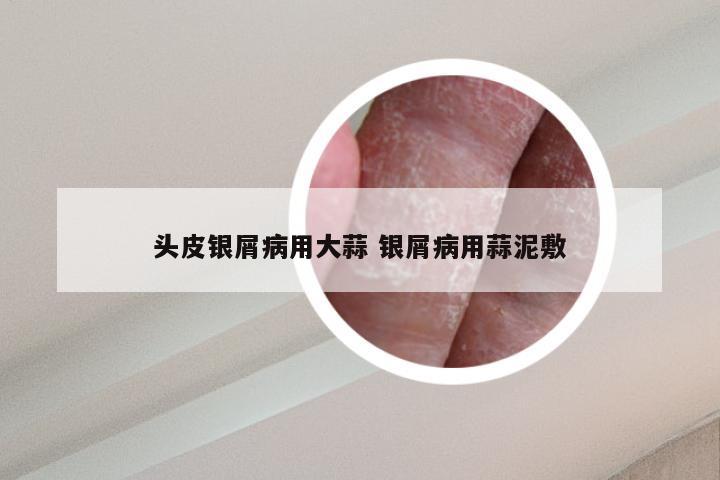 头皮银屑病用大蒜 银屑病用蒜泥敷