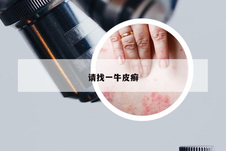 请找一牛皮癣