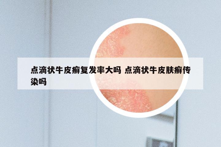 点滴状牛皮癣复发率大吗 点滴状牛皮肤癣传染吗