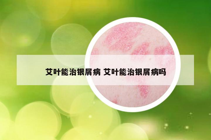 艾叶能治银屑病 艾叶能治银屑病吗