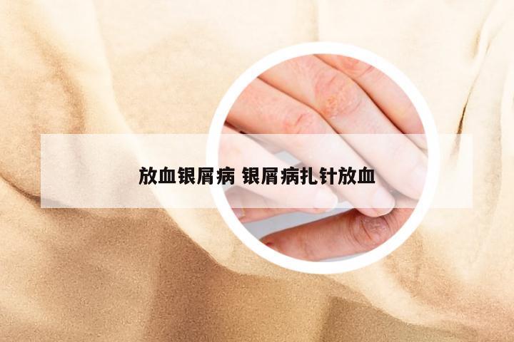 放血银屑病 银屑病扎针放血